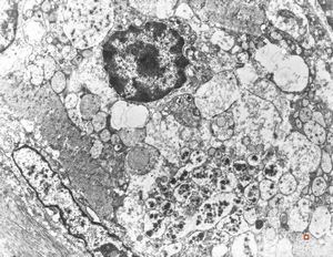 normal seromucinous salivary gland